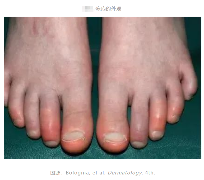 冻疮，图3.png