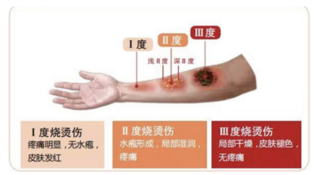 烫伤图1.png