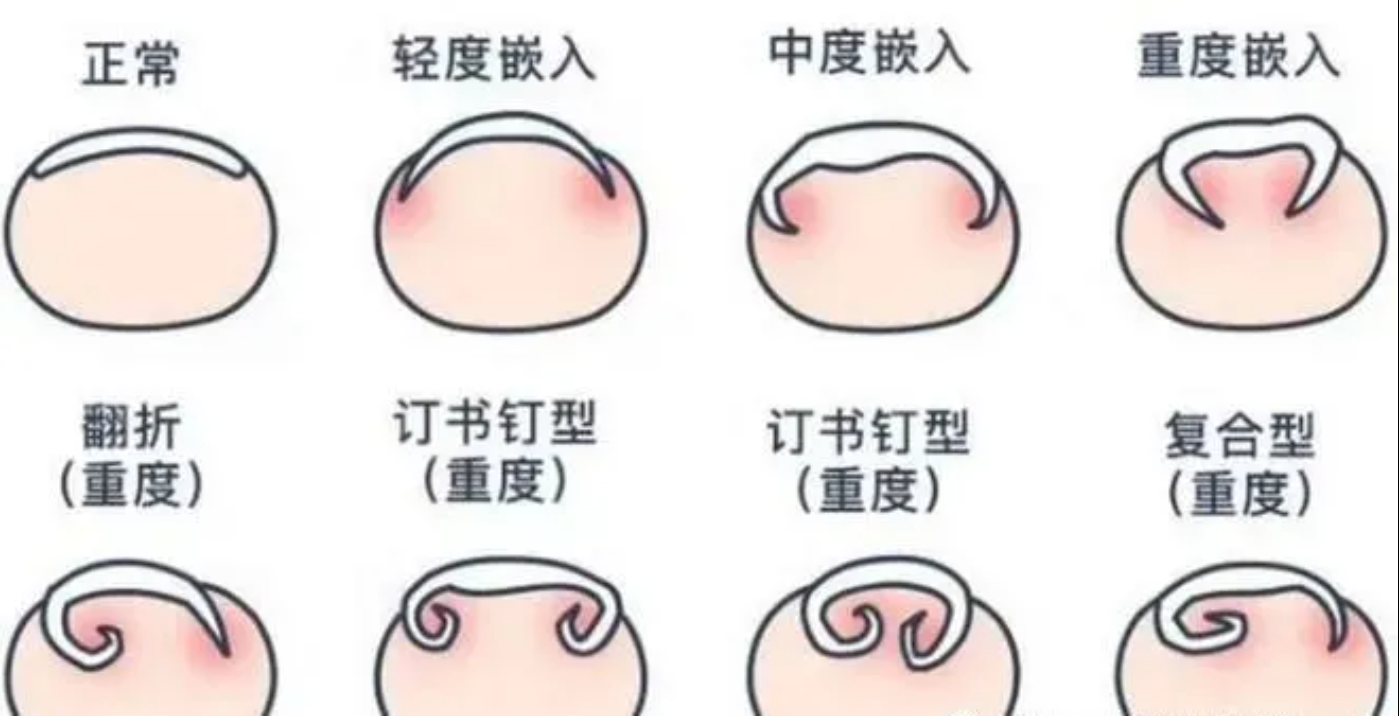 甲沟炎，图3.jpg
