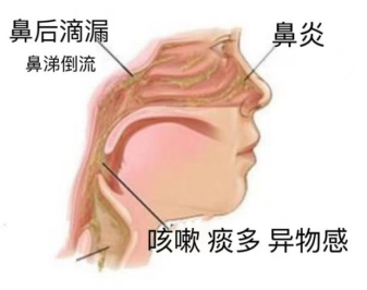 鼻后滴，图2.png